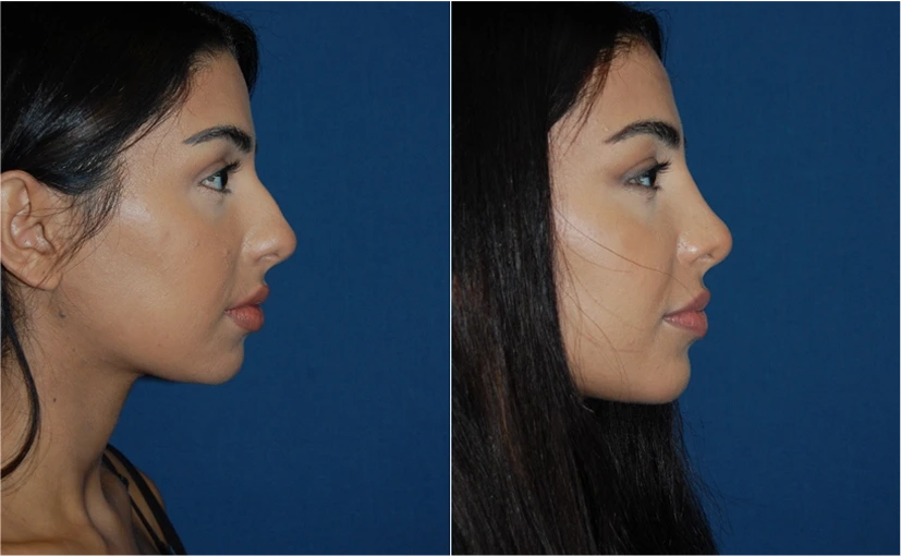 Before & After Pictures: Facial Implants