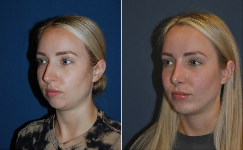 Before & After Pictures: Facial Implants
