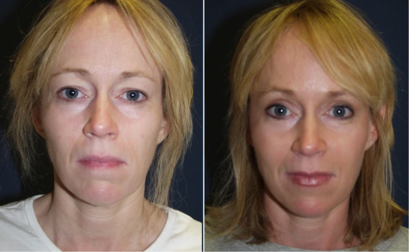 Before & After Pictures: Facial Implants