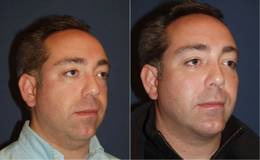 Before & After Pictures: Facial Implants