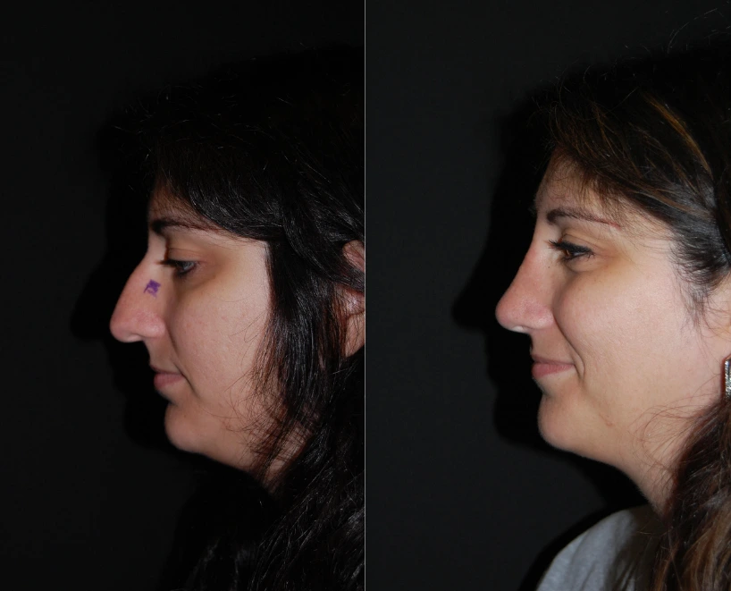 Rhinoplasty (2)