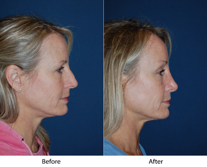 3/4 Brow Lift Before & After Banner