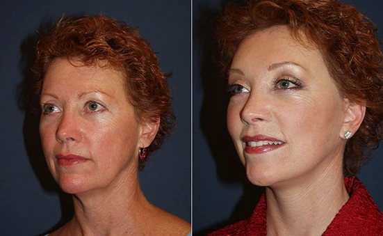 Before & After Gallery: Upper Blepharoplasty