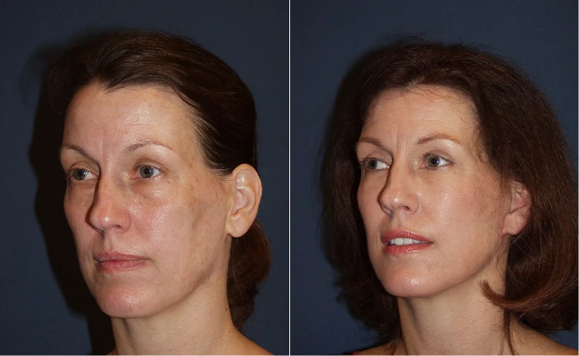 Before & After Gallery: Upper Blepharoplasty