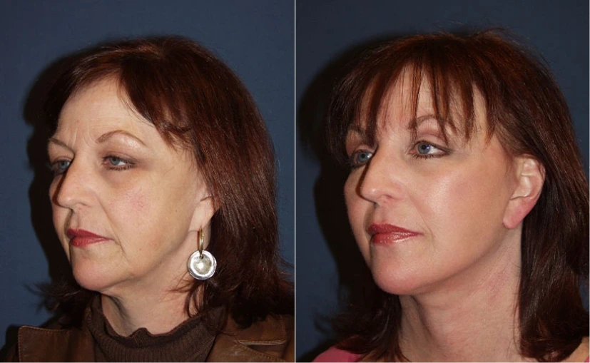 Before & After Gallery: Upper Blepharoplasty