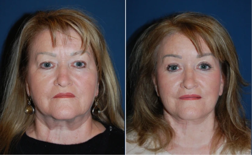 Before & After Gallery: Upper Blepharoplasty