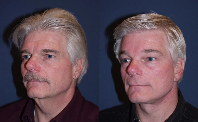 Before & After Gallery: Upper Blepharoplasty