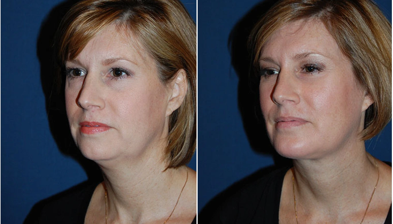 Before & After Necklift Banner