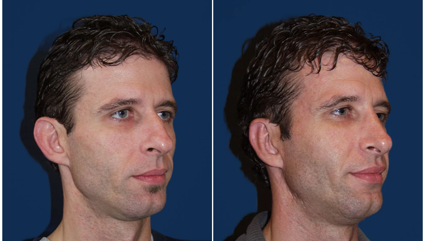 Before & After Otoplasty Banner