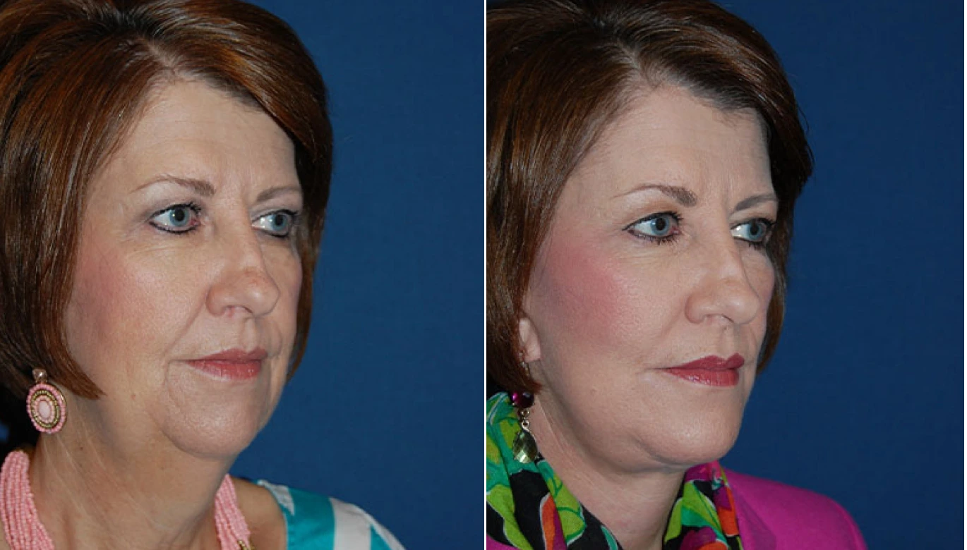 Chin Implant Before & After