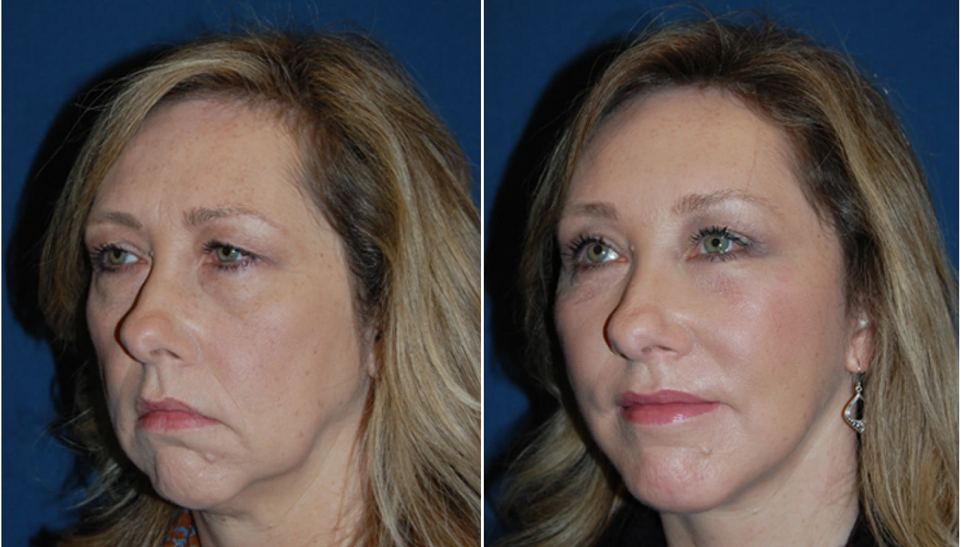 Chin Implant Before & After