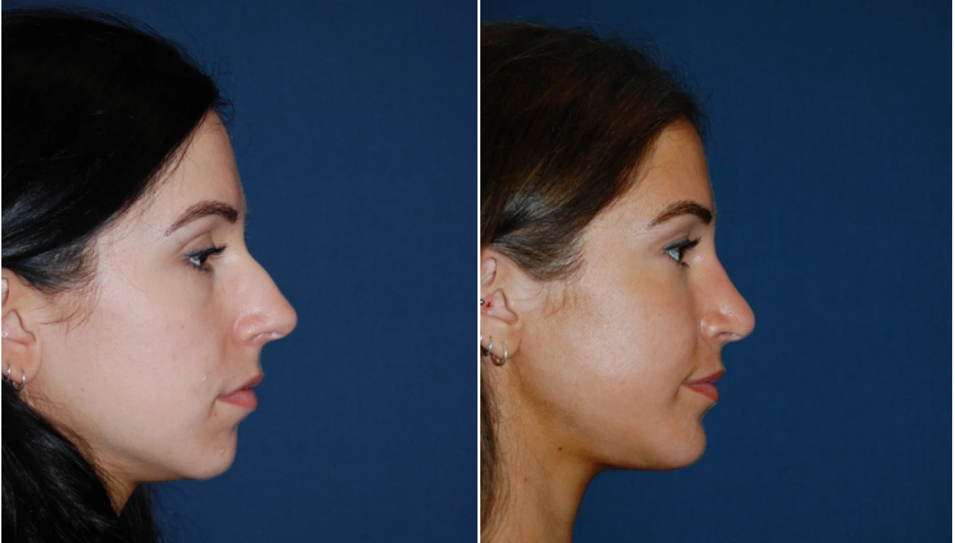 Chin Implant Before & After