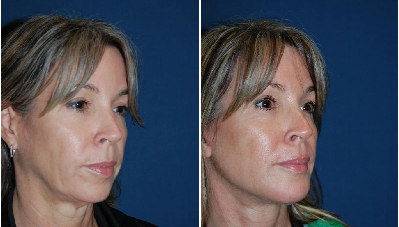 Chin Implant Before & After