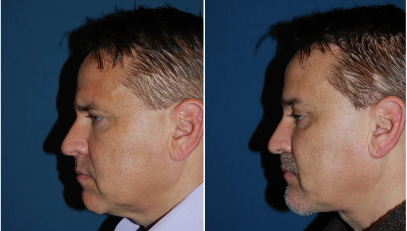 Chin Implant Before & After