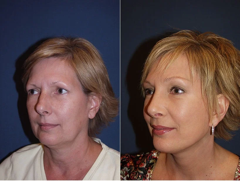Facelift Before & After Results Banner