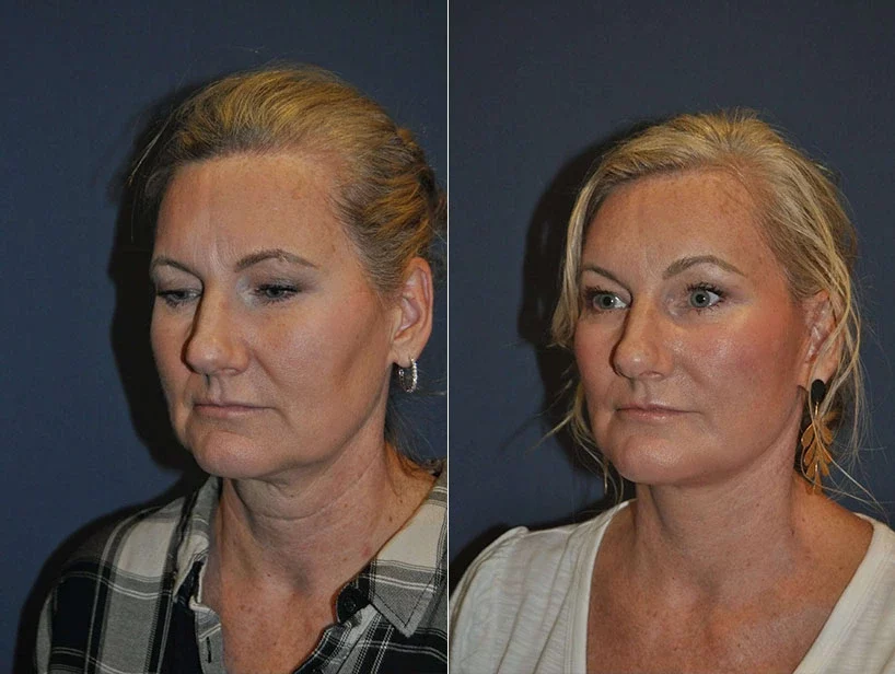 Facelift Before & After Results Banner