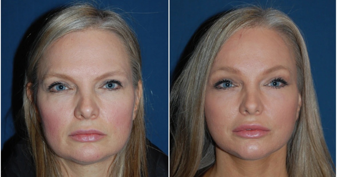 Facelift Before & After banner