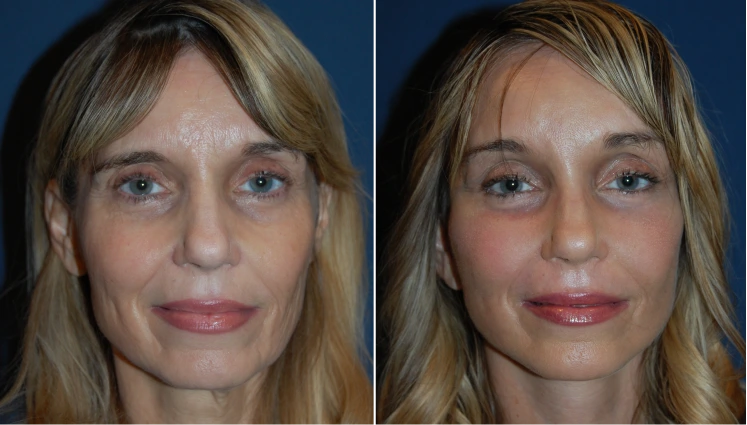 Facelift Before And After Results Banner