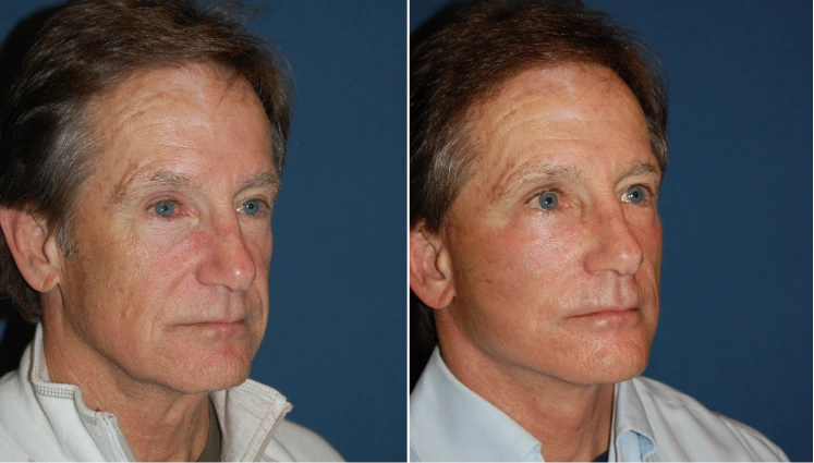 Facelift Before And After Results Banner