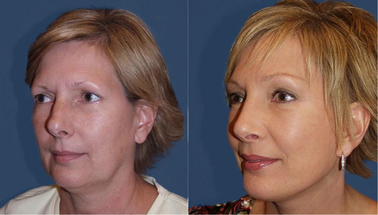 Facelift Before And After Results Banner