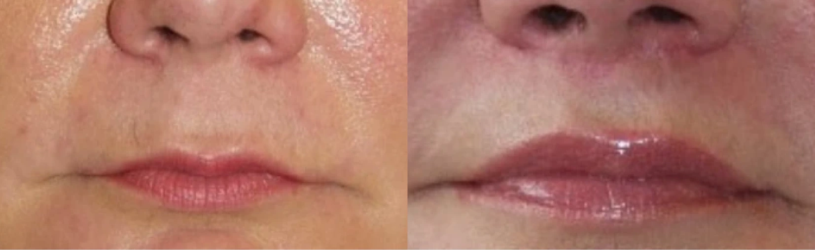 Lip Lift Before & After Banner