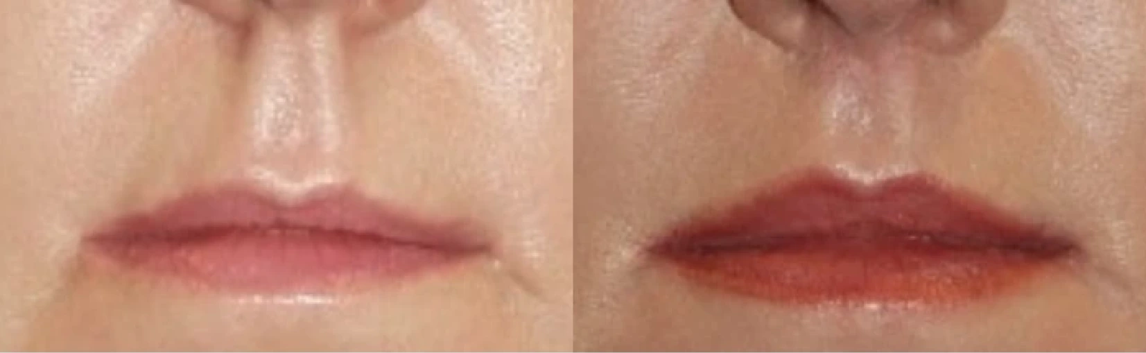 Lip Lift Before & After Banner