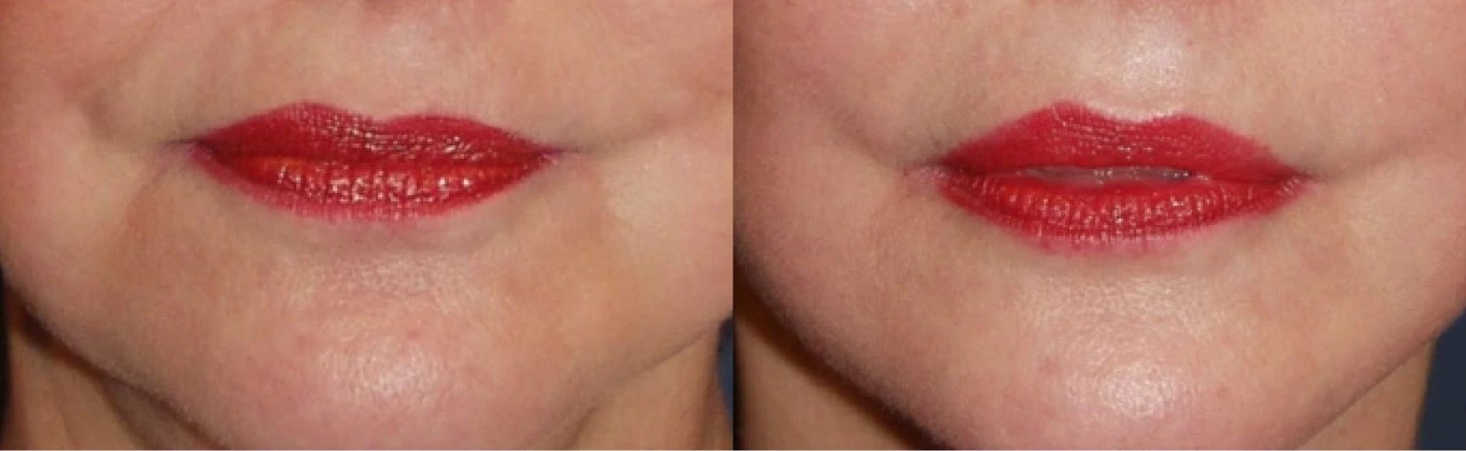 Lip Lift Before & After Banner