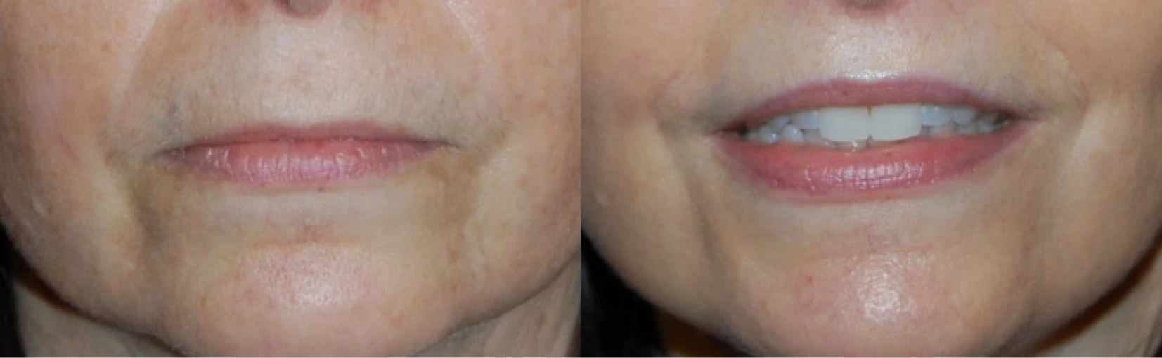 Lip Lift Before & After Banner