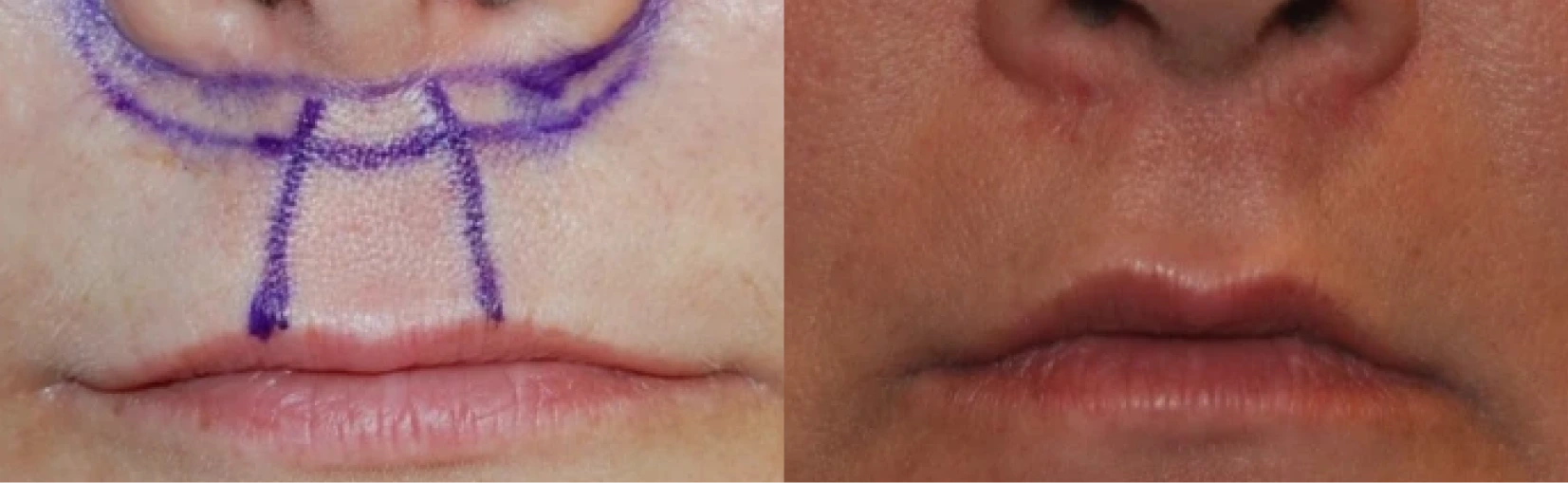 Lip Lift Before & After Banner