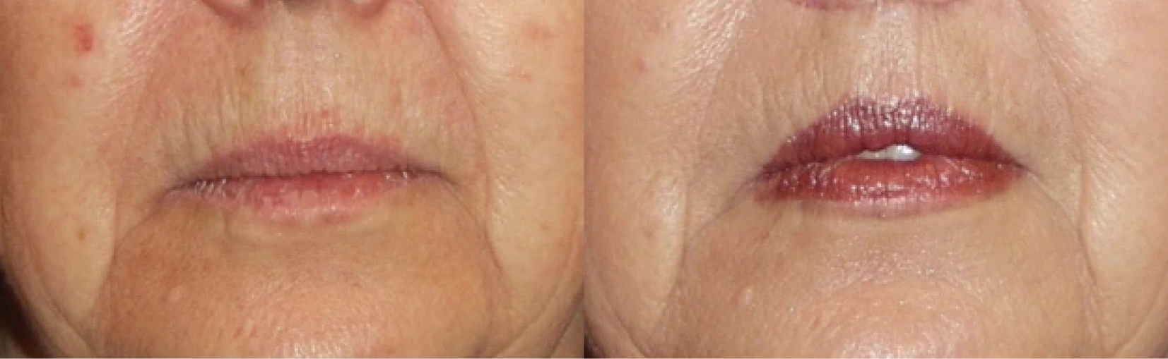 Lip Lift Before & After Banner