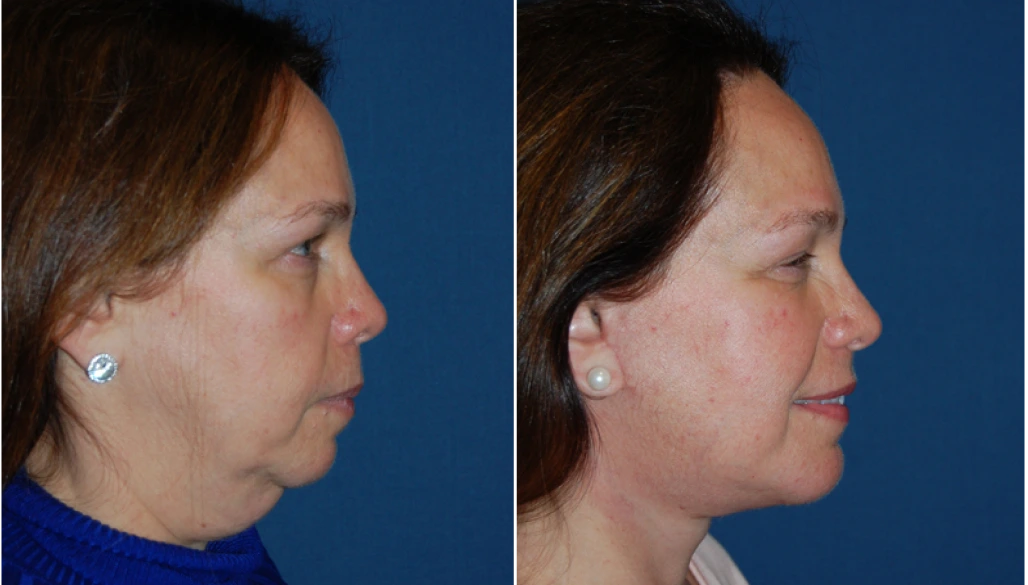 Neck Lift Before & After