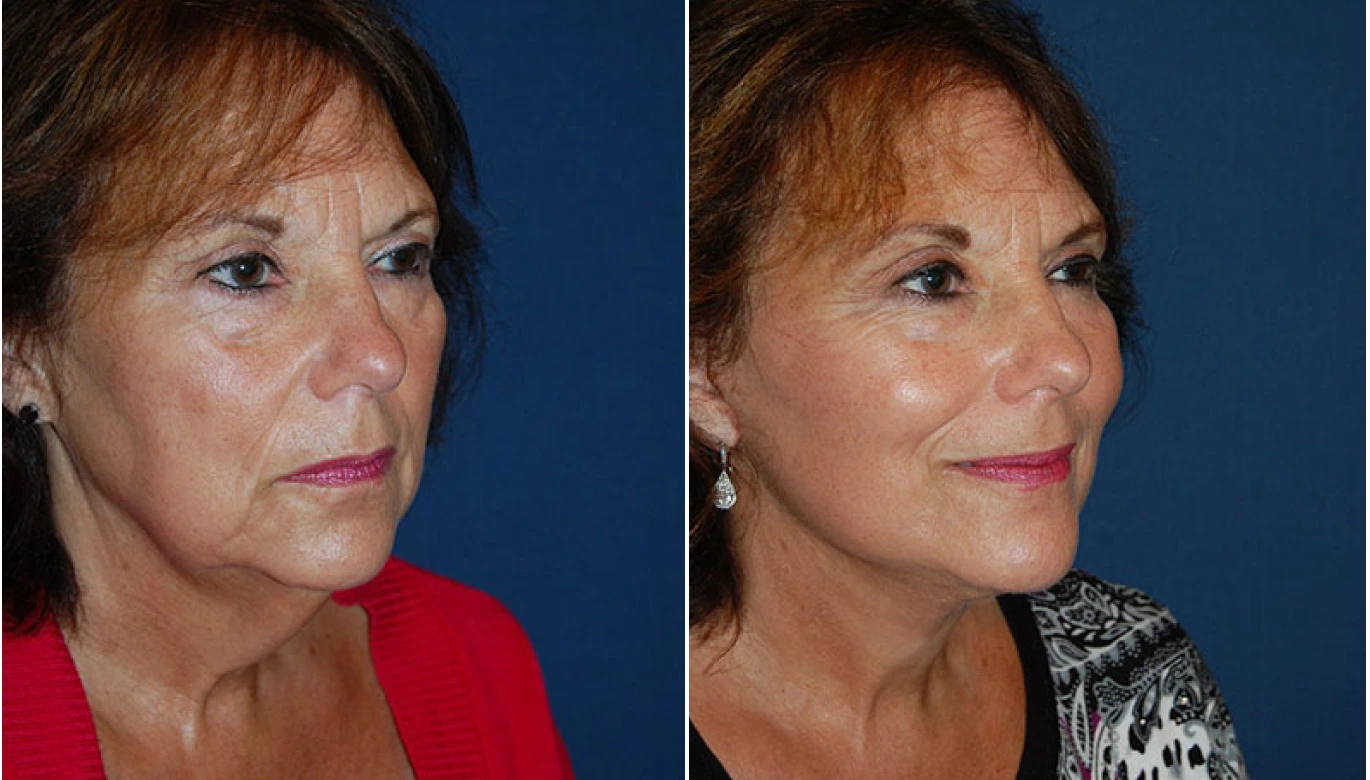 Neck Lift Before & After