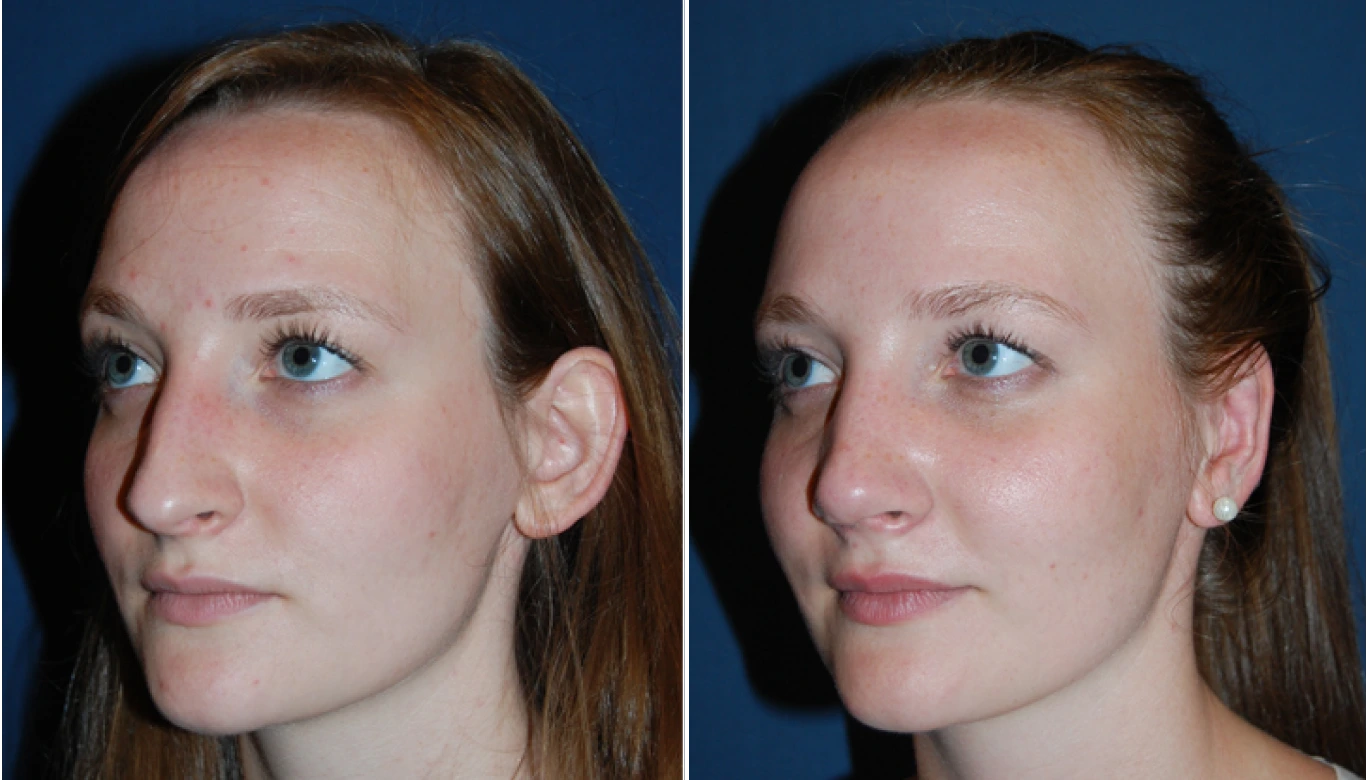 Otoplasty Before & after Banner