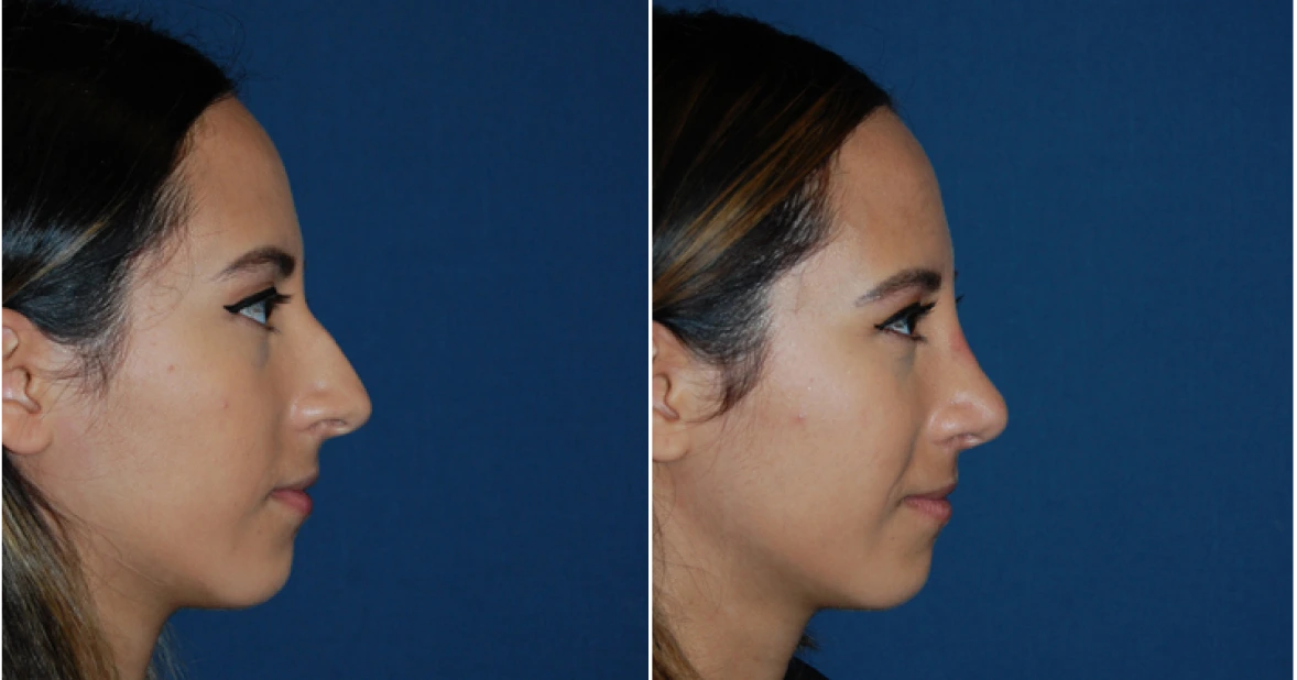 Rhinoplasty Before & After