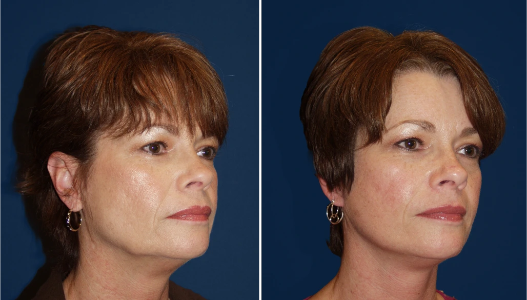 Signature Lift Before & After Banner