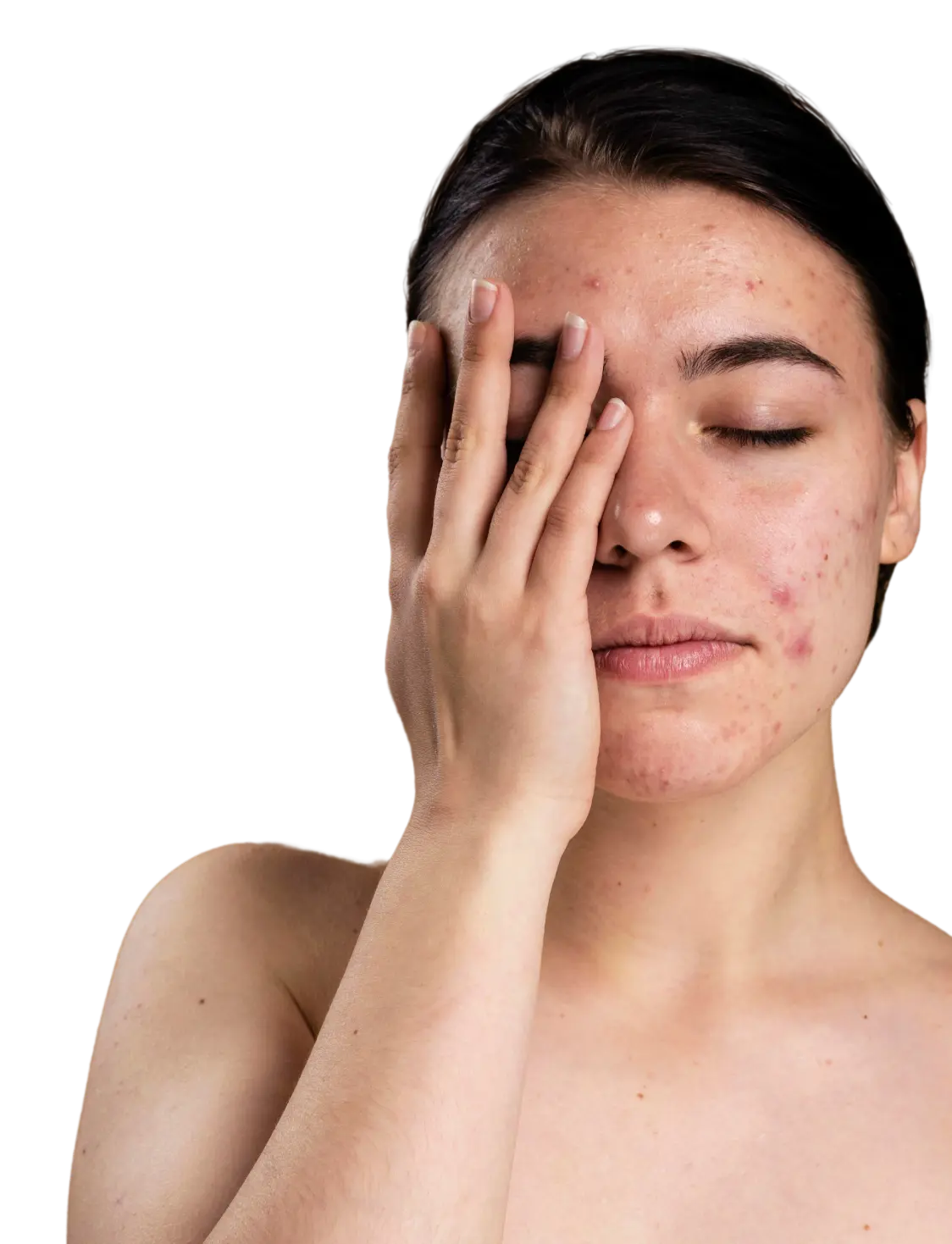 About Acne Scar Treatment