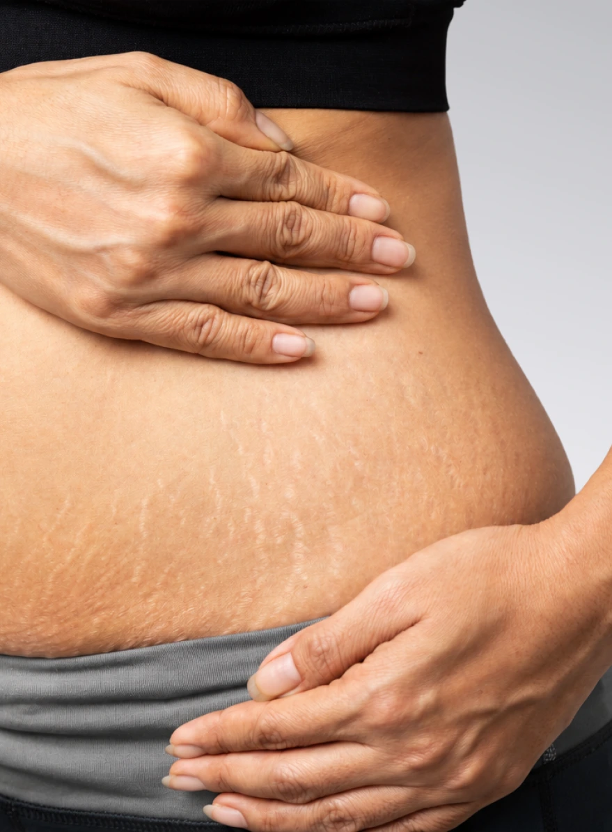 Person's torso with visible stretch marks on abdomen, hands positioned on sides