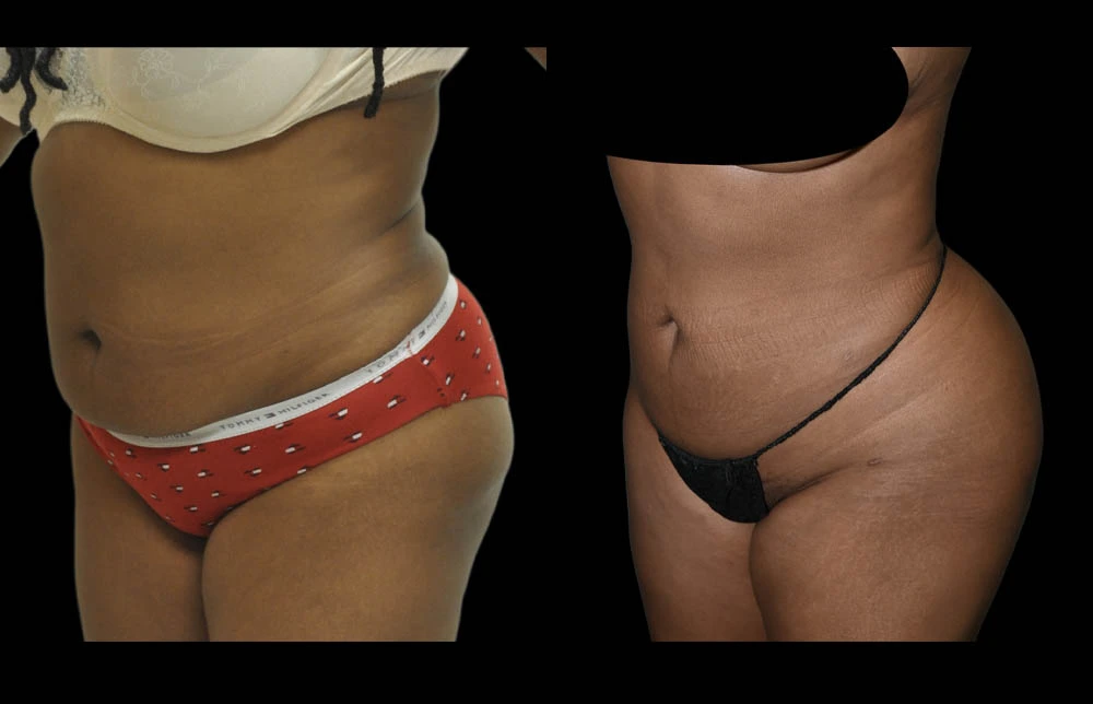 0005_ABDOMEN-LEFT-OBLIQUE-VIEW-BEFORE.jpg (1)