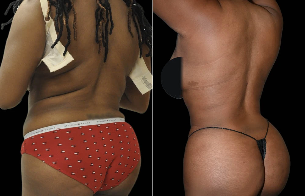 0009_BACK-BUTTOCK-LEFT-OBLIQUE-VIEW-BEFORE.jpg (1)