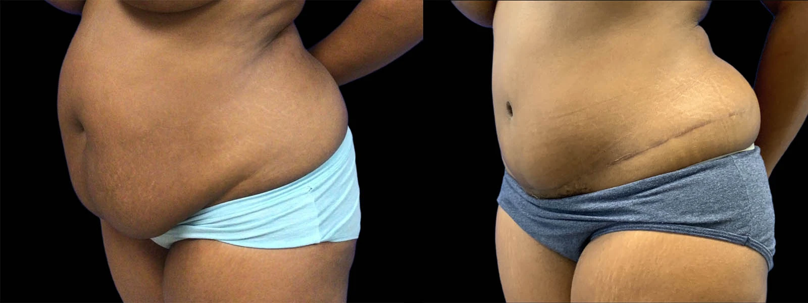 0000_-abdomen-LO-before