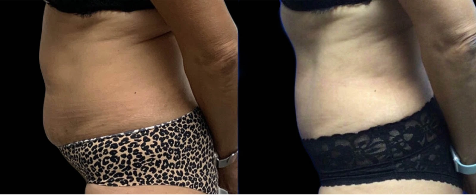 0001_LEFT-LATERAL-VIEW-BA-1.jpg-1