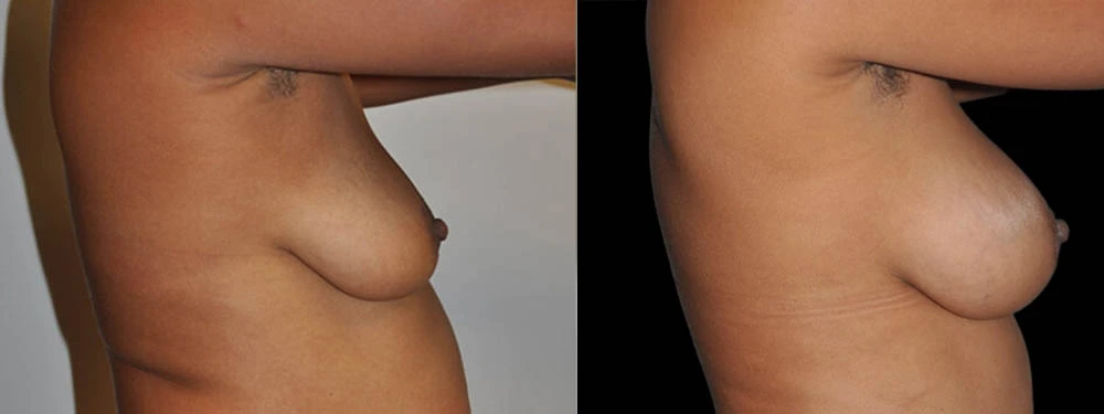 0002_BREASTS-RIGHT-LATERAL-VIEW-AFTER.JPG