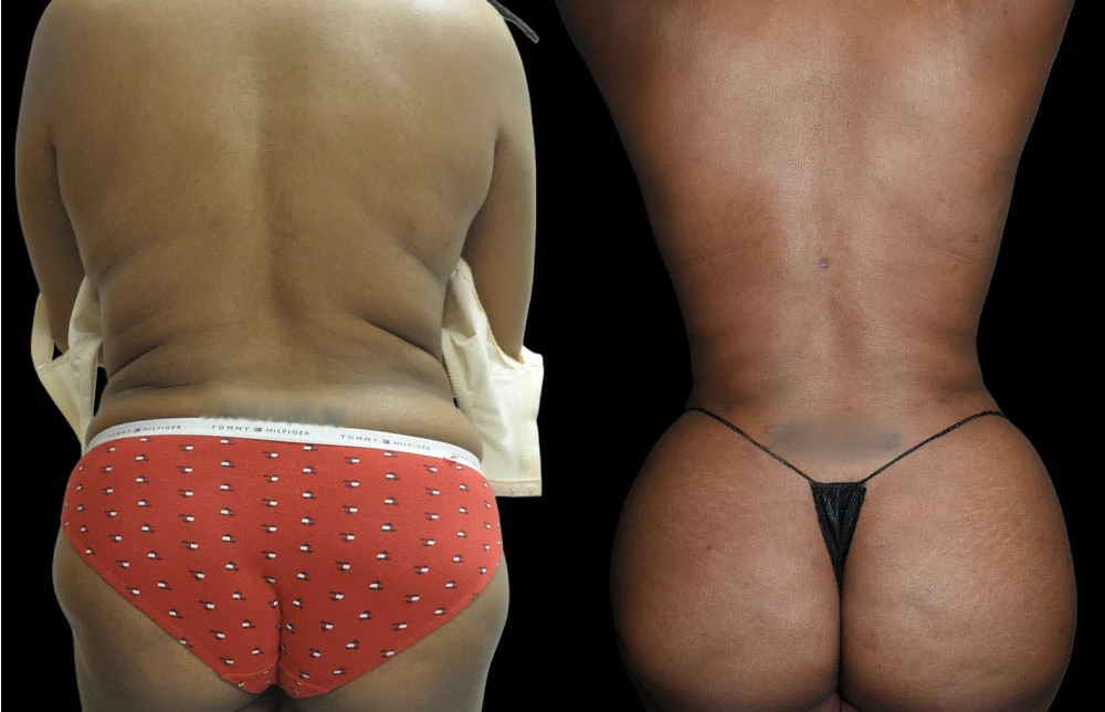 0010_BACK-BUTTOCK-POSTERIOR-VIEW-BEFORE.jpg