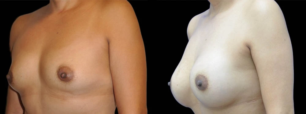 0010_BREASTS-LEFT-OBLIQUE-VIEW-AFTER.jpeg