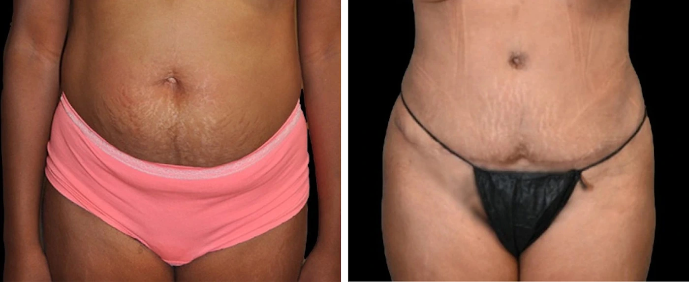 Before and after liposuction case 11-14: front view shows flatter, more defined abdomen after treatment