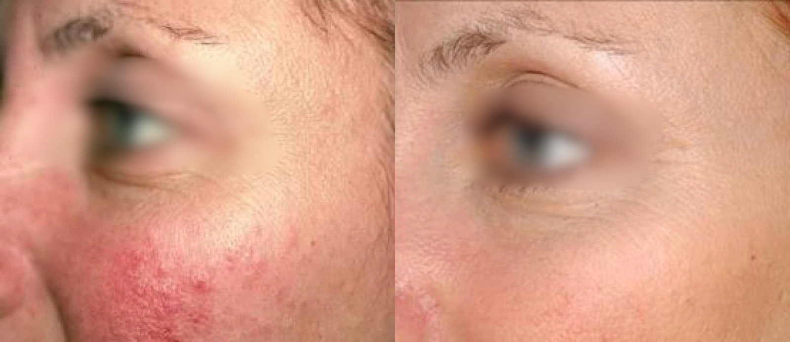 Before and after comparison of facial skin texture and redness improvement from Laser Genesis treatment