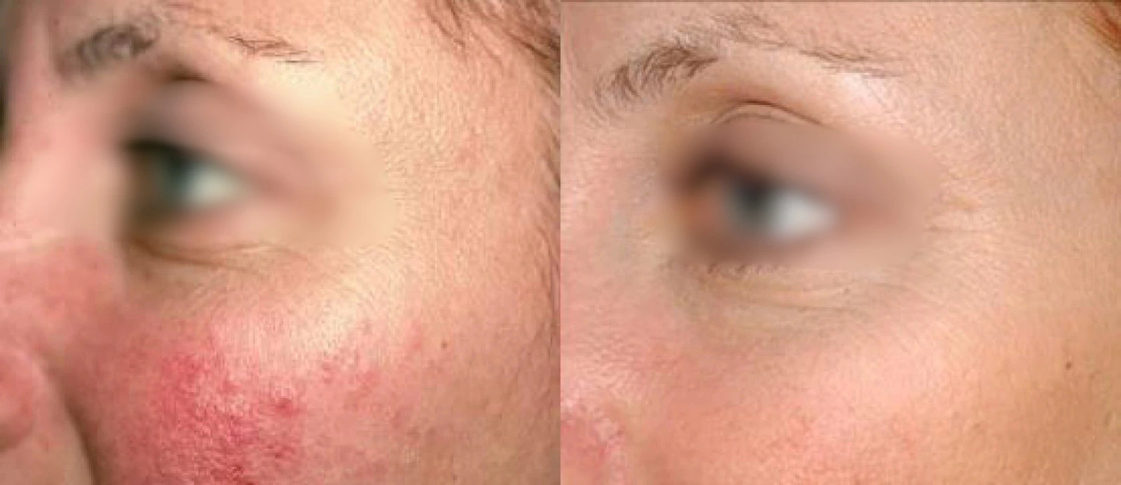 Before and after comparison of facial skin texture and redness improvement from Laser Genesis treatment