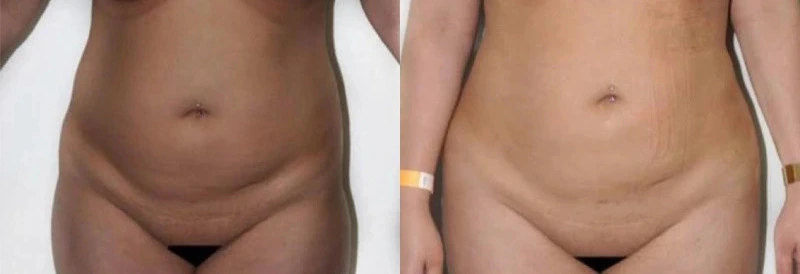 Before and after liposuction: front view shows reduced abdominal fullness and improved waist definition