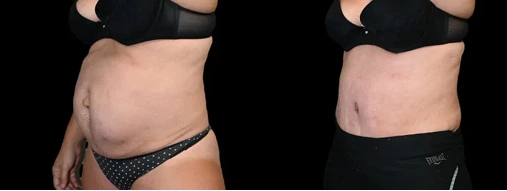 Before & After: Tummy Tuck