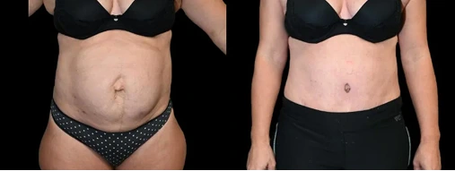 Before & After: Tummy Tuck
